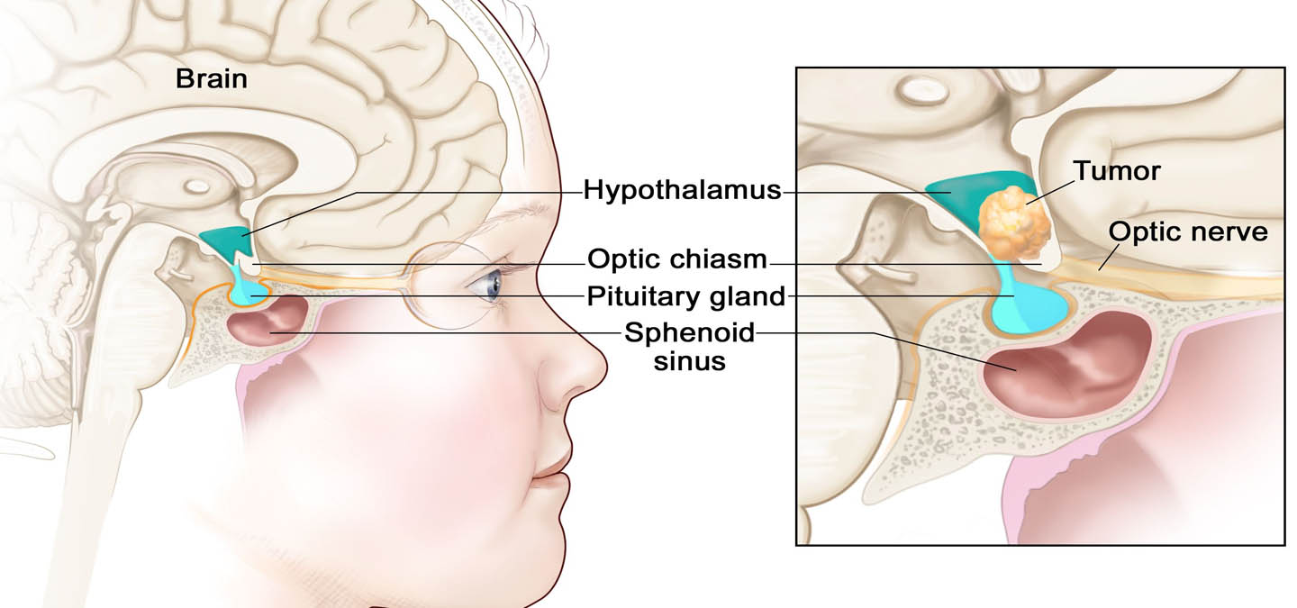 Glioma Surgery