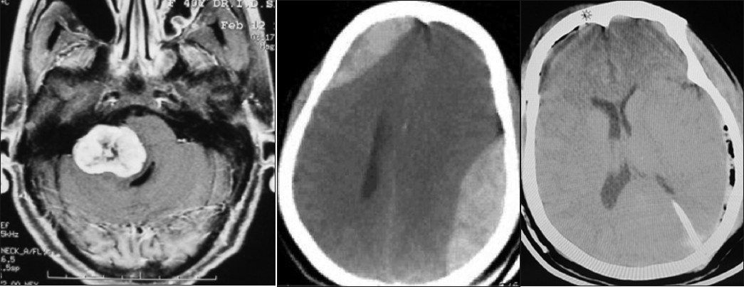 Glioma Surgery