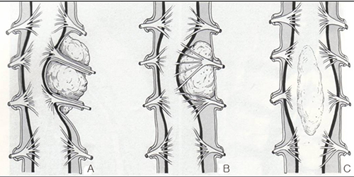 Glioma Surgery