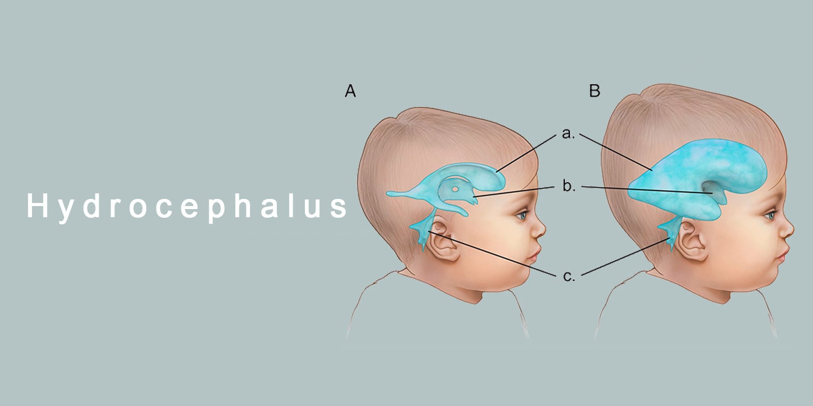 Glioma Surgery